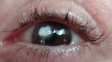 Belmo pe ochiul unei persoane (leucoma) cauzează opacitatea corneei prin codul μb-10, cum se tratează, se elimină