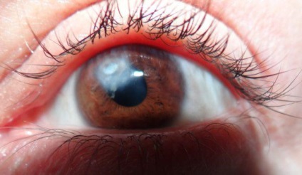 Belmo pe ochiul unei persoane (leucoma) cauzează opacitatea corneei prin codul μb-10, cum se tratează, se elimină