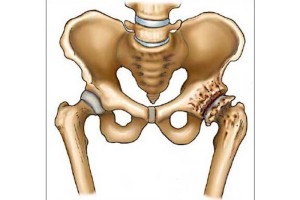 Boli ale simptomelor și tratamentului articulațiilor șoldului