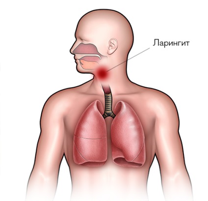 Dureri gât tipuri, simptome, tratament