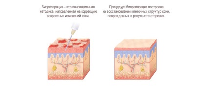 Ce este mai bine de ales - biorevitalizarea sau bioremedierea