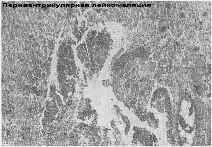 Care este boala - accentul gliozei cerebrale, o clinică modernă pentru tratamentul neurologic