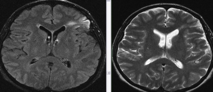 Care este boala - accentul gliozei cerebrale, o clinică modernă pentru tratamentul neurologic