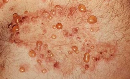 Dermatitis Dryinga herpetiform leírás, tünetek, kezelési módok