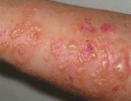 Dermatită cauze și simptome de dermatită
