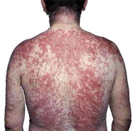 Dermatită cauze și simptome de dermatită