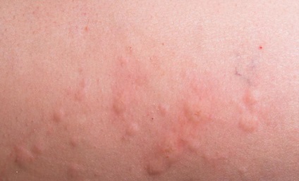 Dermatita simptome, tipuri și tratamentul dermatitei cutanate la adulți