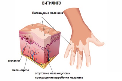 Dieta si nutritie terapeutica cu vitiligo meniu, retete