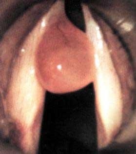 Neoplasmul laryngeal benign provoacă prognosticul