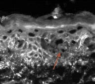 Exprimarea moleculelor de adeziune celulară a complexului de cadherină și rolul acestora în diagnosticul de