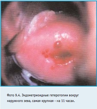 Endometrioza simptomelor, cauzelor și tratamentului cervixului - centrul de laparoscopie din Moscova