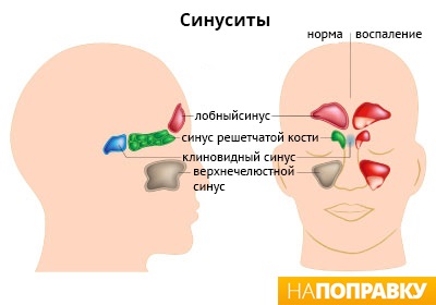 Flux (periostită) simptome și metode de tratament -