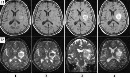 Hemoragie provoacă accident vascular cerebral, semne, prevenire