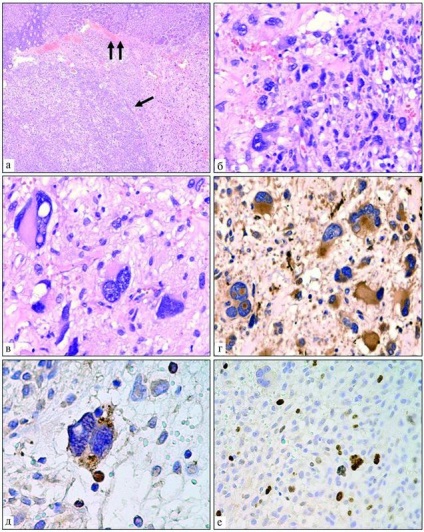 Sarcomul gastric histiocitar - arhiva patologiei - 2013-01 - editura 