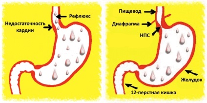 Amărăciunea în gură și cauzele arsurilor la stomac, diagnosticul, tratamentul