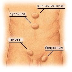 Herniated abdomen