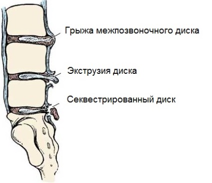 Tipuri de discuri herniate și clasificarea herniilor intervertebrale