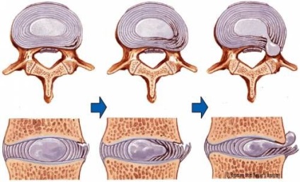 Tipuri de discuri herniate și clasificarea herniilor intervertebrale