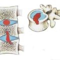 Hernia simptomelor și tratamentului coloanei vertebrale toracice