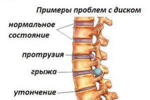 Instrucțiuni pentru utilizarea tantalului medicamentos în hernia coloanei vertebrale