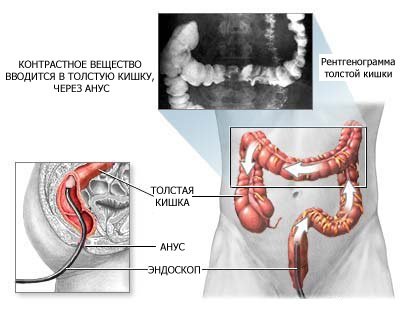 Irigozcopia intestinului - ce este și cum se face