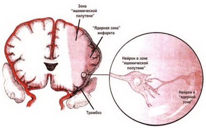 Ischemia simptomelor creierului, cum să diagnosticați și să tratați boala