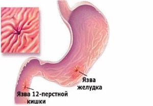 Din cauza stomacului care suferă după alcool și de ce este imposibil să bei pe foame și la ulcer gastric