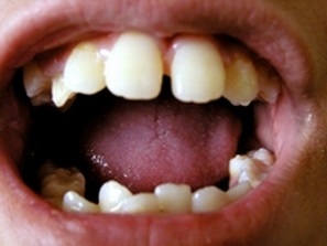Cum să scapi de durerea de dinți fără droguri
