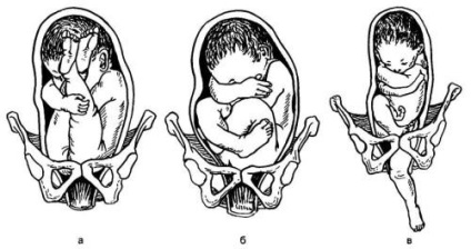Care este prezentarea fătului în timpul sarcinii - sarcină