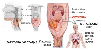 Cum apare cancerul gâtului (laringelui)