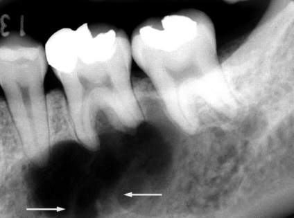 Cyst simptome dinte, cauze de debut, complicații și tratamente