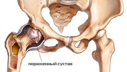 Coxita articulației șoldului la copii și adulți cauze și tratament