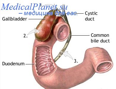 Tratamentul conservator al colecistitei acute