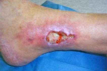Vörös foltok a lábakon, amikor a hasnyálmirigyek problémákat, fotókat és kezelést okoznak