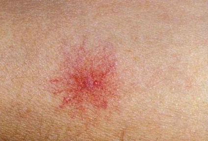 Care sunt petele de la varicoza Pata rosie pe picior cu tratament cu varice