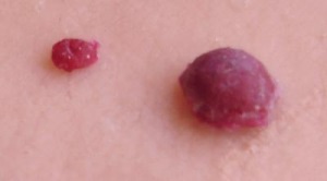 Red moles pe corpul cauzei apariției