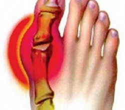 Tratamentul tratamentului artrozei piciorului, simptome și metode de tratament