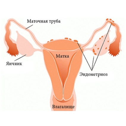 Tratamentul endometriozei uterului la Samara