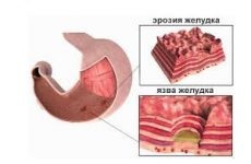 Tratamentul gastritei cu remedii populare