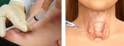 Tratamentul nodulilor tiroidieni fără intervenție chirurgicală Metodele tradiționale și populare