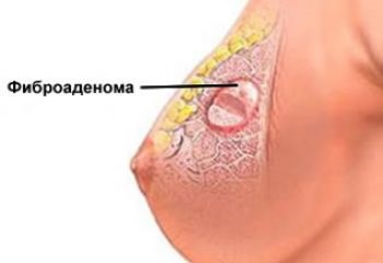 Radioterapia pentru eficacitatea metodei cancerului de col uterin și feedback-ul pacientului