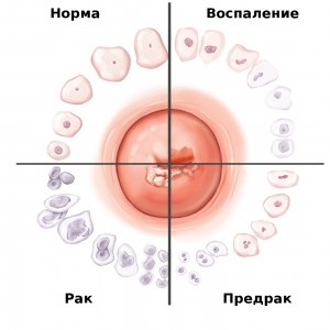 Radioterapia pentru eficacitatea metodei cancerului de col uterin și feedback-ul pacientului