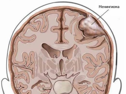 Meningiomul lobului frontal (frontal) al creierului