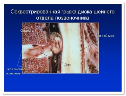 Hernia intervertebrală a coloanei vertebrale cervicale - motive, tratament