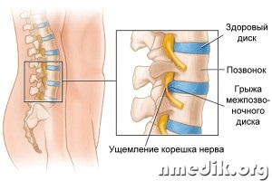 Hernia intervertebrală - simptome și tratament