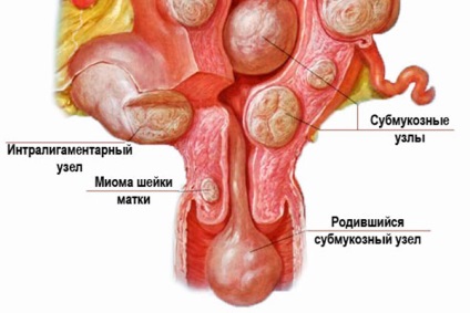 Myoma a méh és a méhnyak