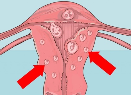 Myomul uterului și colului uterin