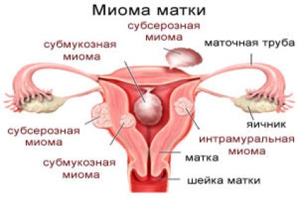 Myomul uterului și colului uterin