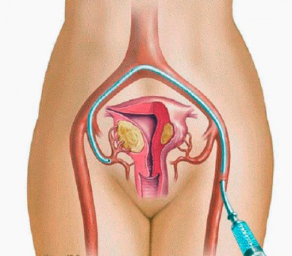 Myomul uterului și colului uterin