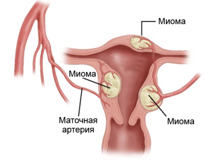 Myomul speciei uterine, cauzele, simptomele și tratamentul
